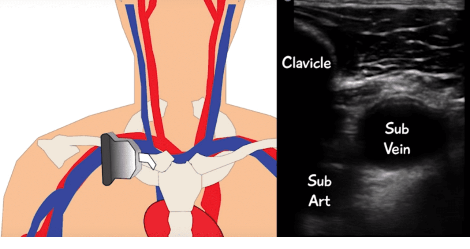 The Subclavian Line – The Line of Champions - Emergency Medicine Training