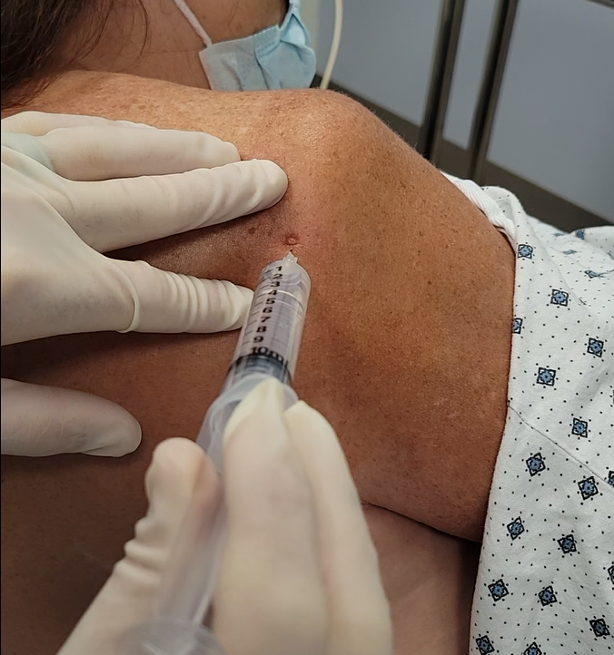 posterior approach intraarticular injection in a patient for awake shoulder reduction