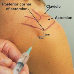 Demonstration of a posterior shoulder intraarticular injection for awake shoulder reduction